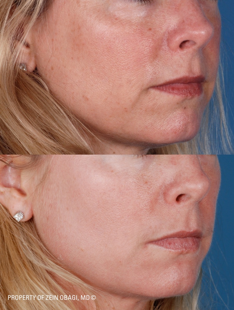 ZO® Professional Skin Care Before and After