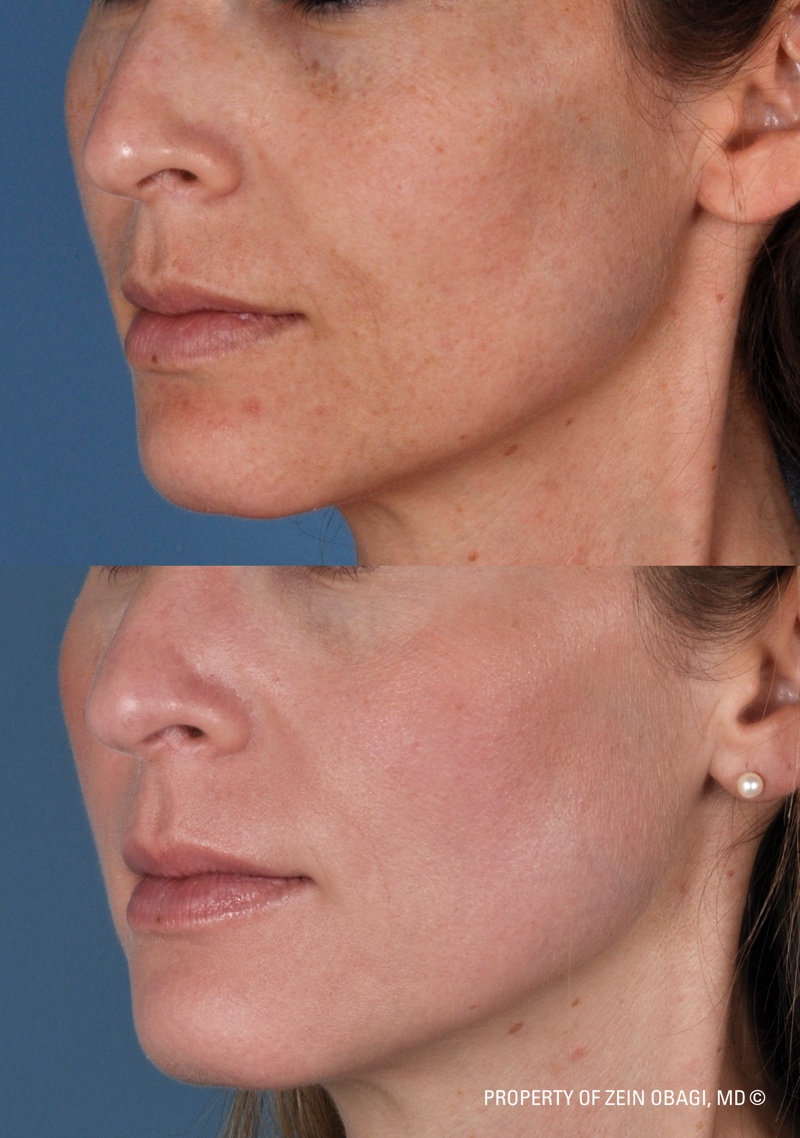 ZO® Professional Skin Care Before and After