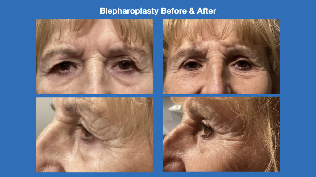 ADV Med Spa Services Video Blepharoplasty Before and After