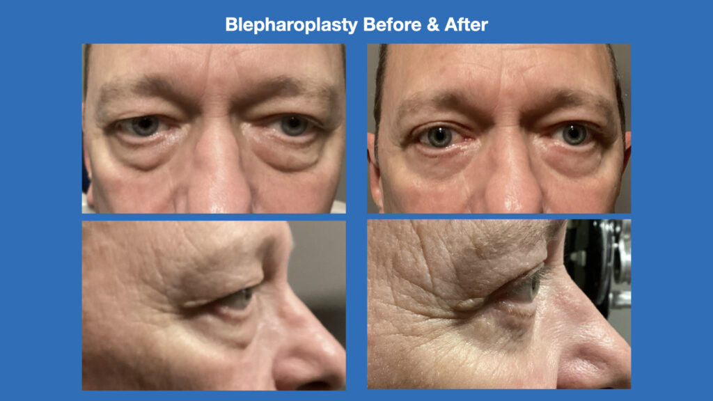 ADV Med Spa Services Video Blepharoplasty Before and After