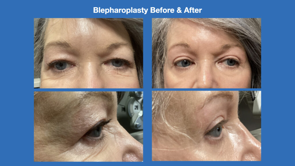 ADV Med Spa Services Video Blepharoplasty Before and After