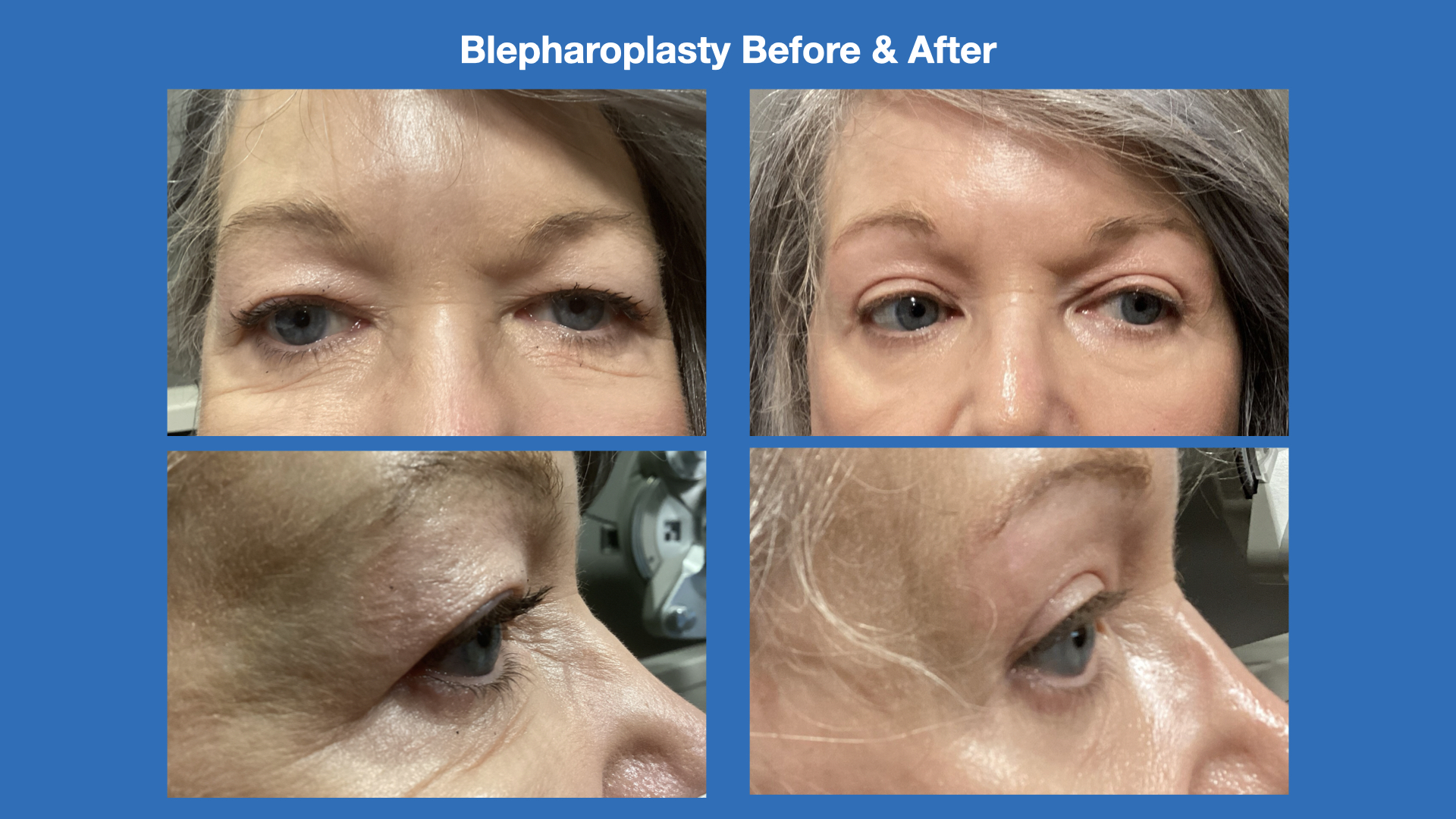 ADV Med Spa Services Video Blepharoplasty Before and After