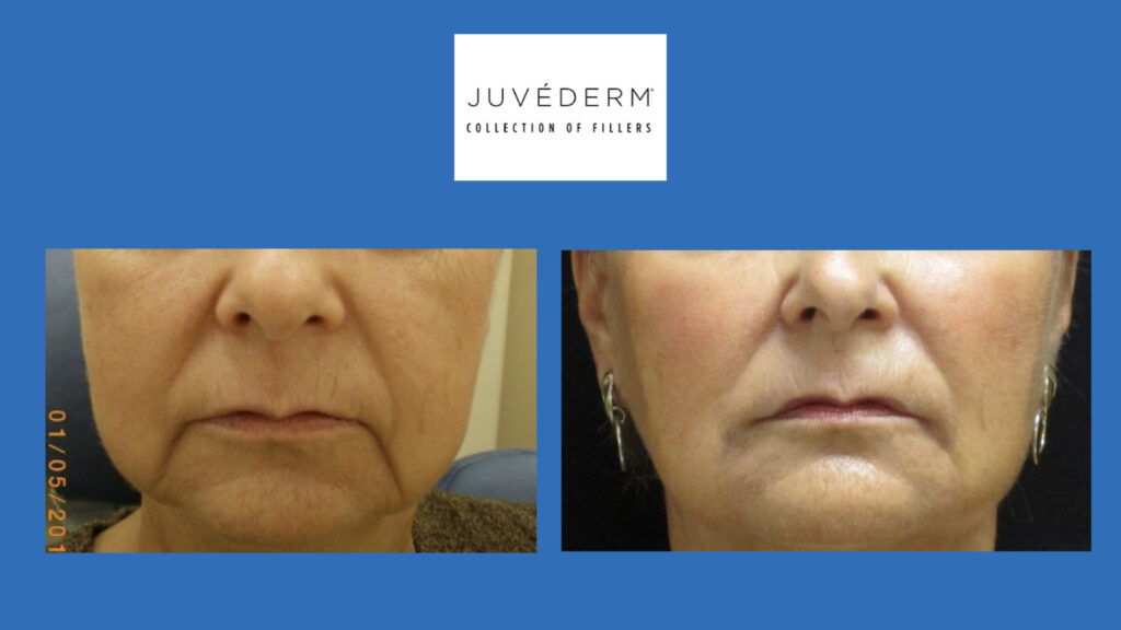 ADV Med Spa Services Video JUVÉDERM Collection of Fillers