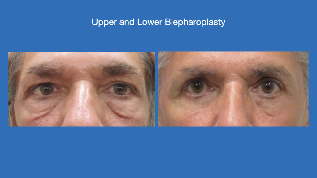 ADV Med Spa Services Video Upper and lower Blepharoplasty Before and After