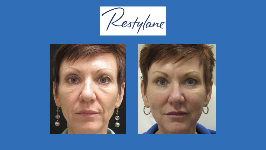 ADV Med Spa Services Video Restylane