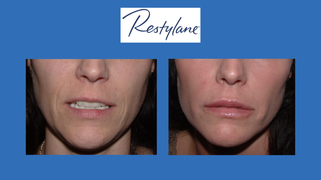 ADV Med Spa Services Video Restylane
