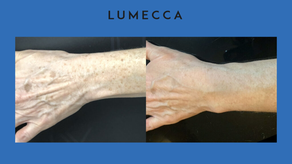 ADV Med Spa Services Video Lumecca Before and After