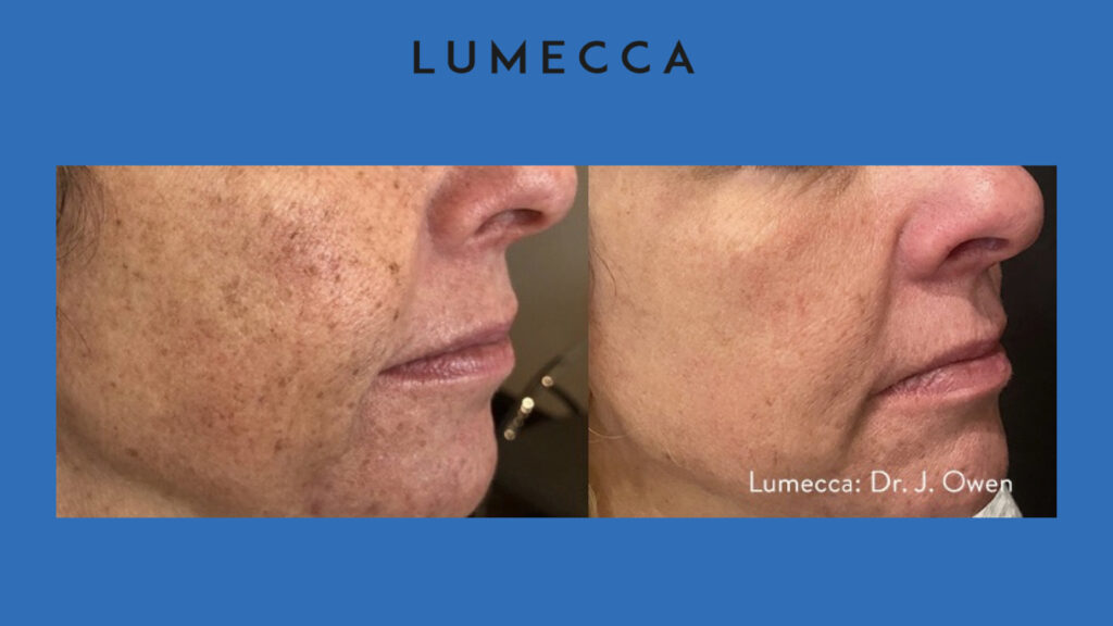 ADV Med Spa Services Video Lumecca Before and After