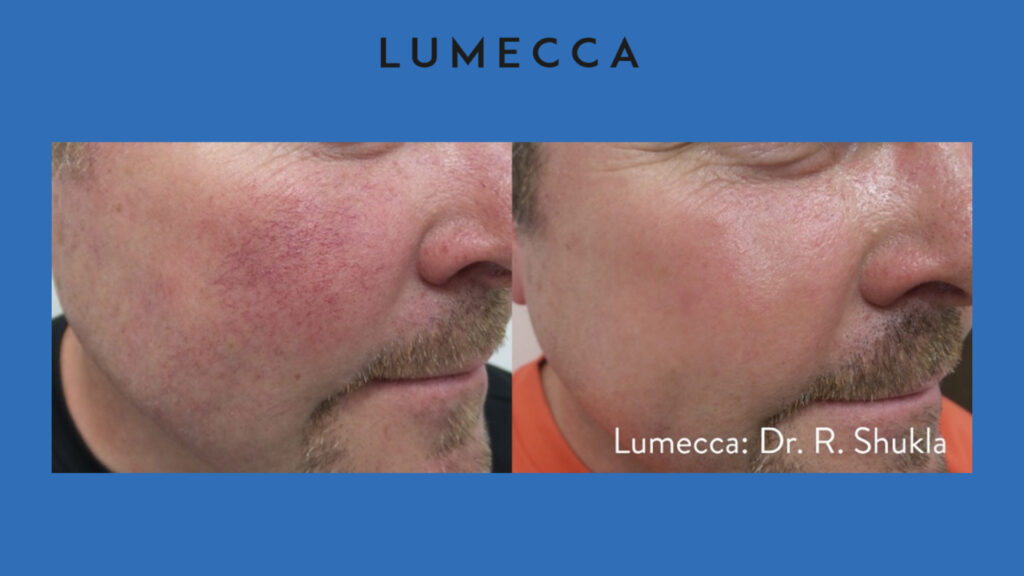 ADV Med Spa Services Video Lumecca Before and After