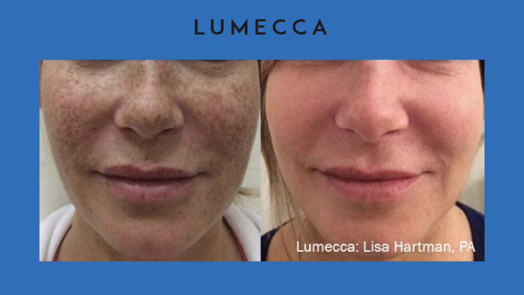 ADV Med Spa Services Video Lumecca Before and After