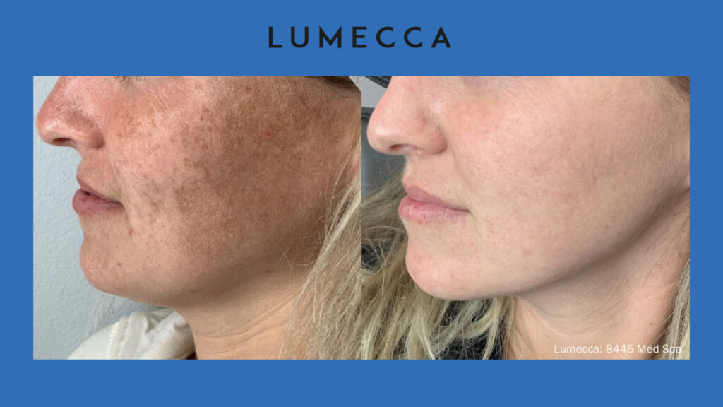ADV Med Spa Services Video Lumecca Before and After