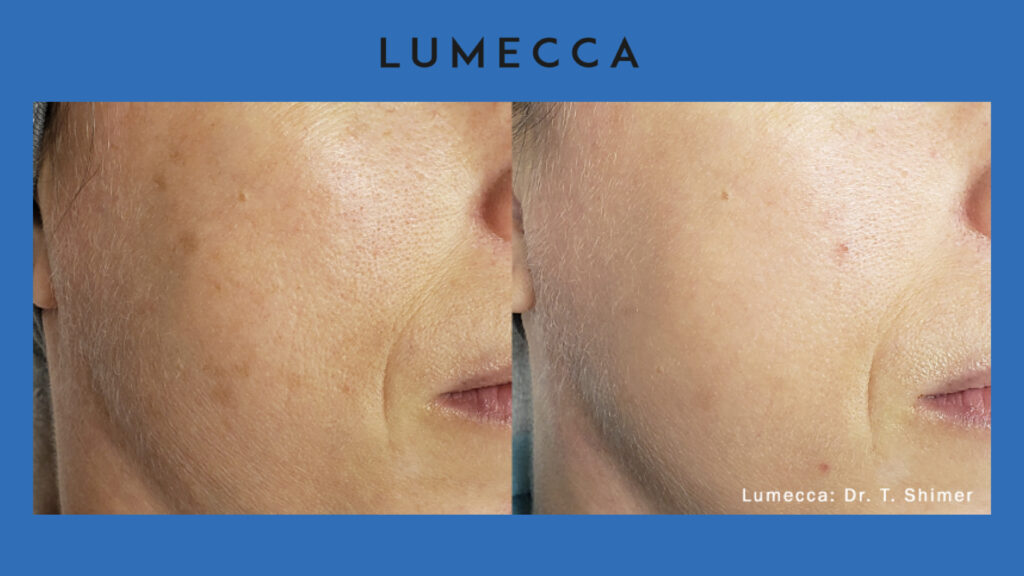 ADV Med Spa Services Video Lumecca Before and After