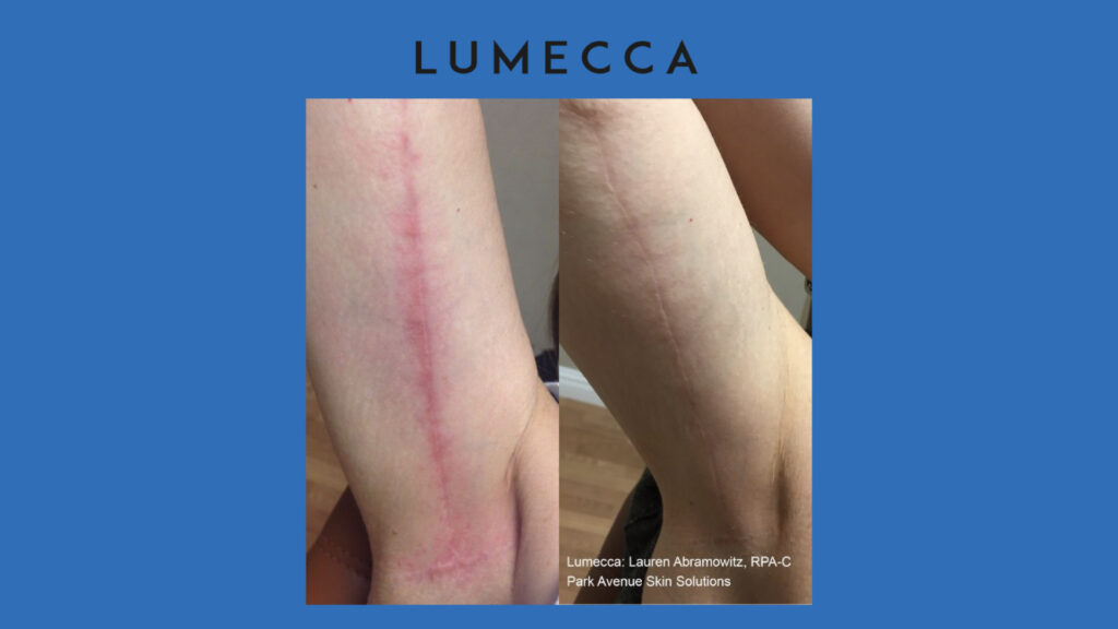 ADV Med Spa Services Video Lumecca Before and After