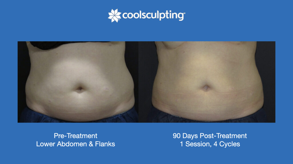 ADV Med Spa Services Video Coolsculpting®