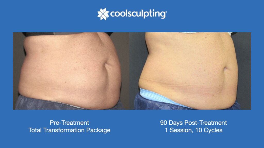 ADV Med Spa Services Video Coolsculpting®