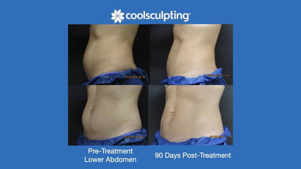 ADV Med Spa Services Video Coolsculpting®