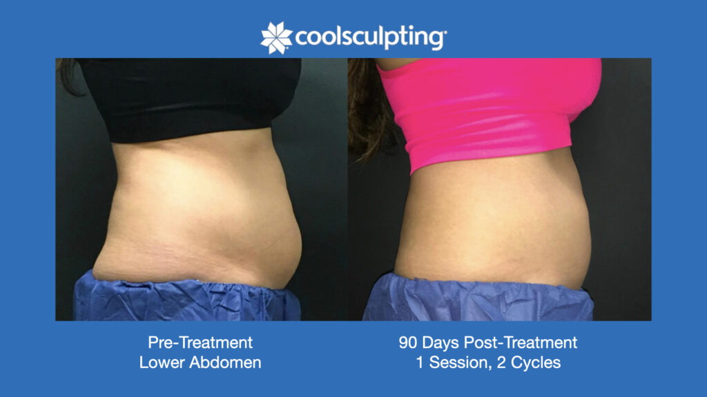 ADV Med Spa Services Video Coolsculpting®