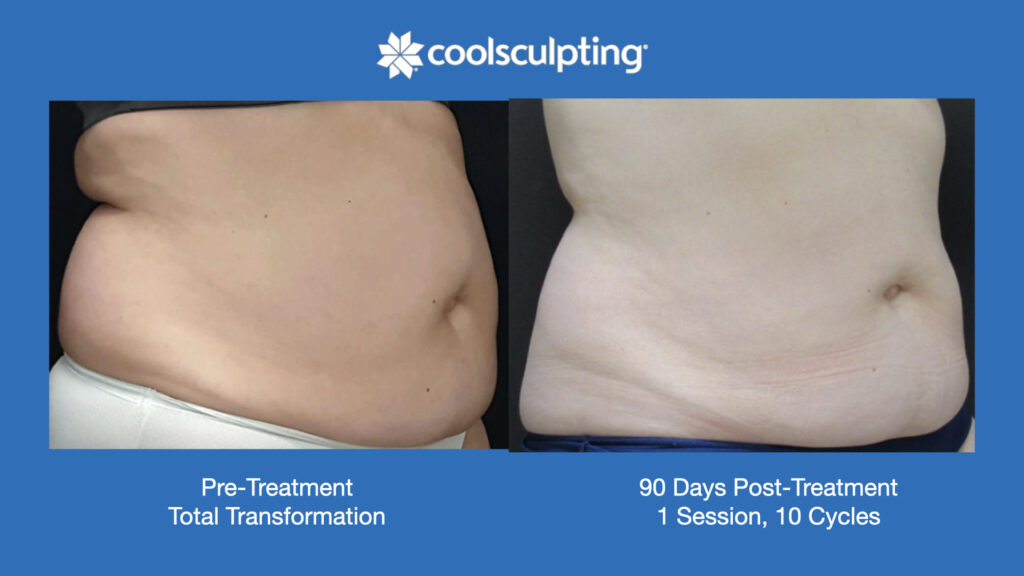 ADV Med Spa Services Video Coolsculpting®