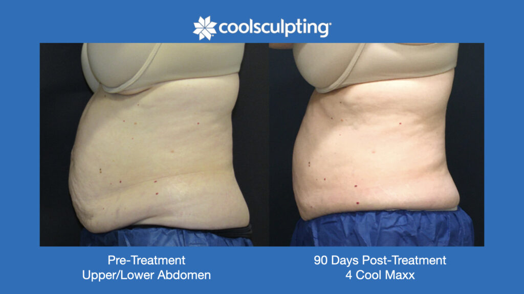 ADV Med Spa Services Video Coolsculpting®
