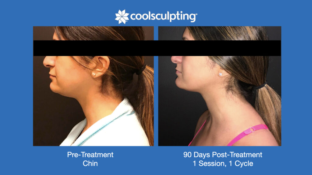 ADV Med Spa Services Video Coolsculpting®