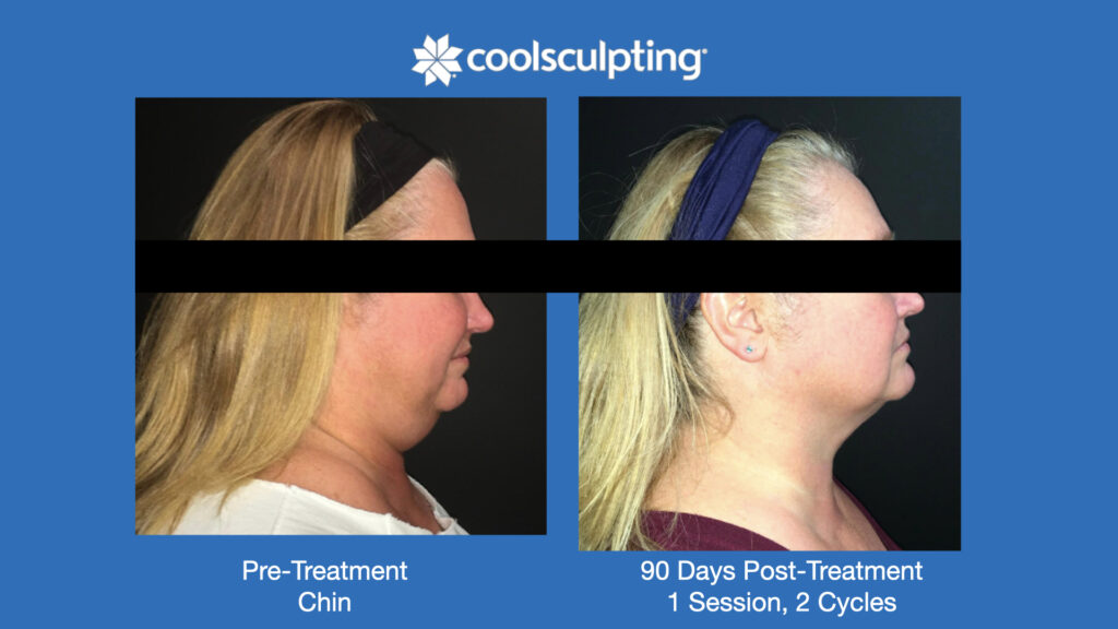 ADV Med Spa Services Video Coolsculpting®