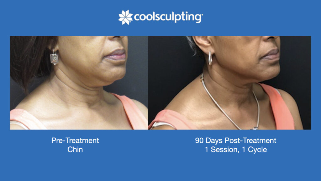 ADV Med Spa Services Video Coolsculpting®