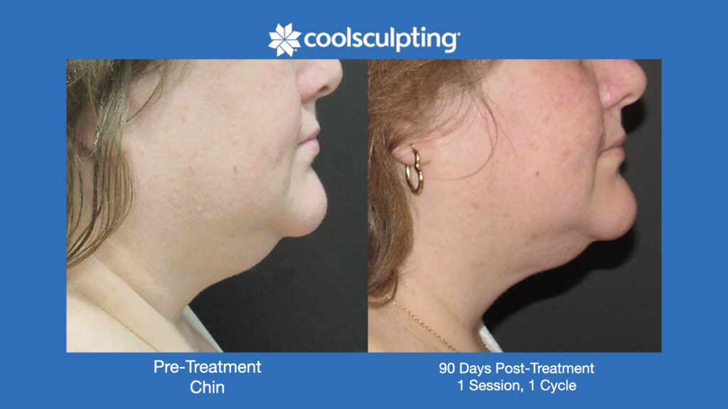 ADV Med Spa Services Video Coolsculpting®
