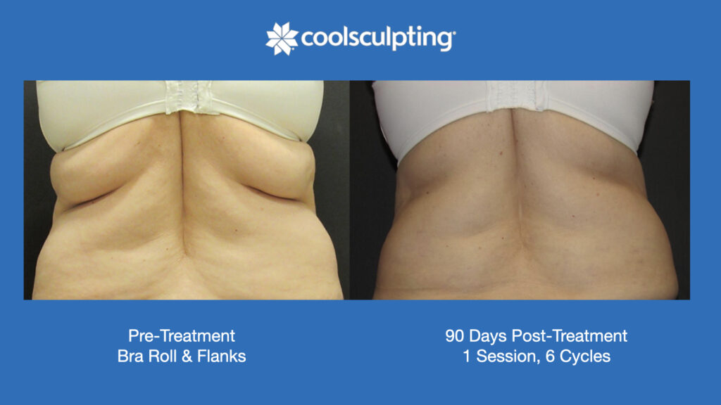 ADV Med Spa Services Video Coolsculpting®