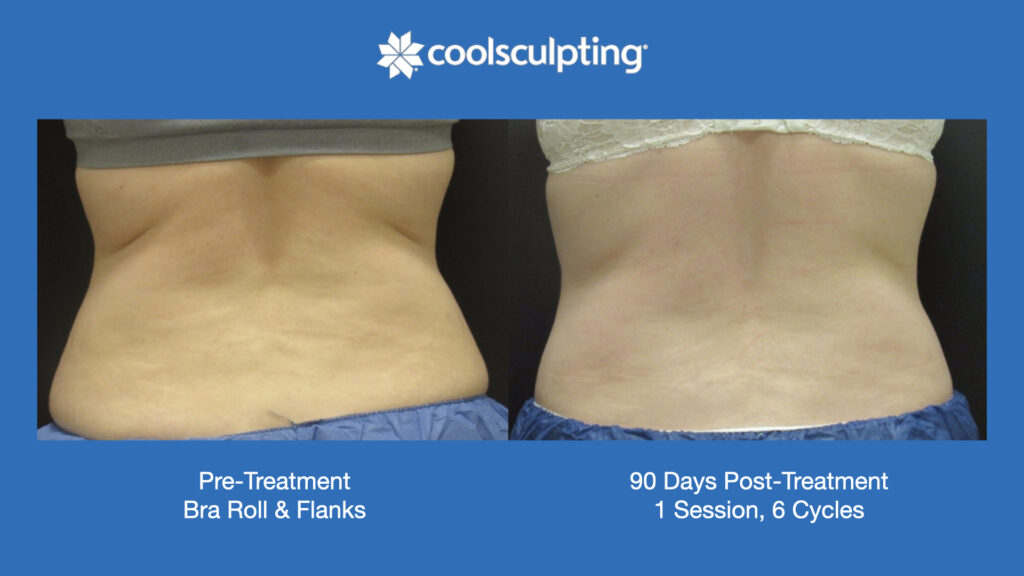 ADV Med Spa Services Video Coolsculpting®