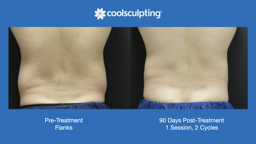 ADV Med Spa Services Video Coolsculpting®