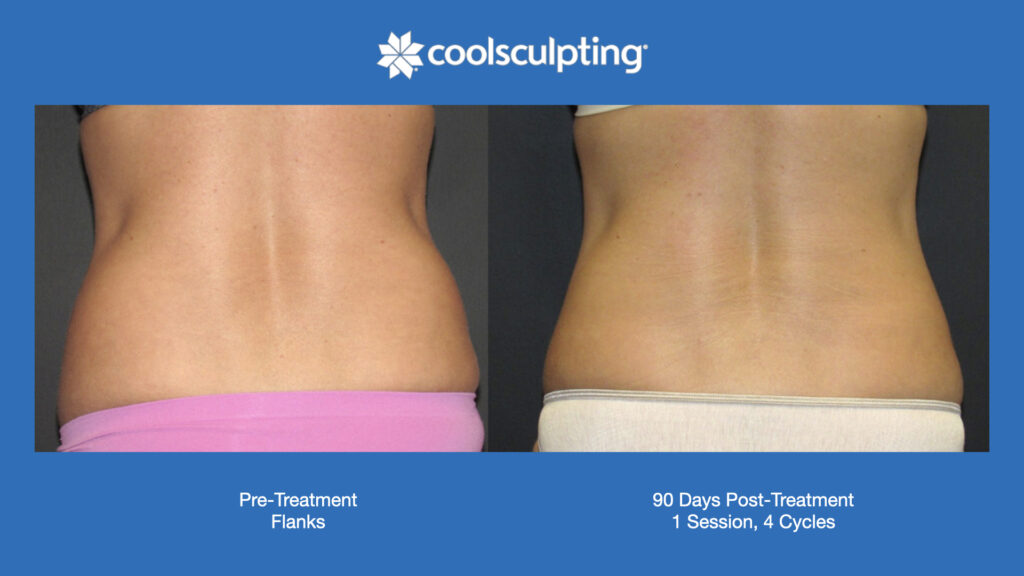 ADV Med Spa Services Video Coolsculpting®