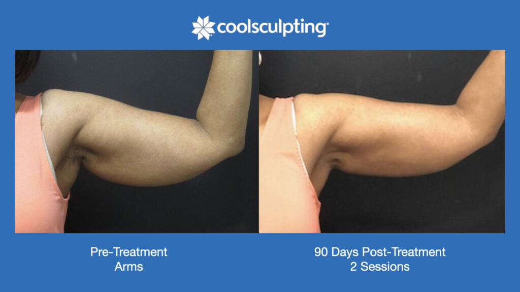 ADV Med Spa Services Video Coolsculpting®