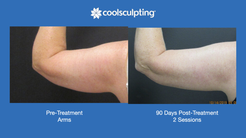 ADV Med Spa Services Video Coolsculpting®