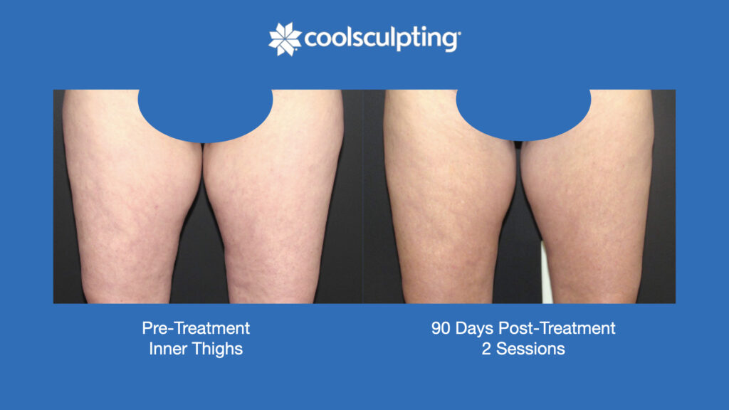 ADV Med Spa Services Video Coolsculpting®