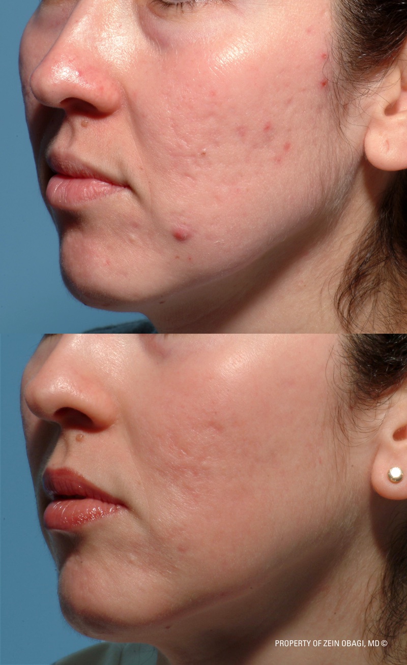 ZO® Professional Skin Care Before and After