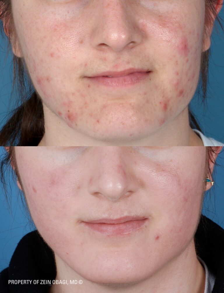 ZO® Professional Skin Care Before and After