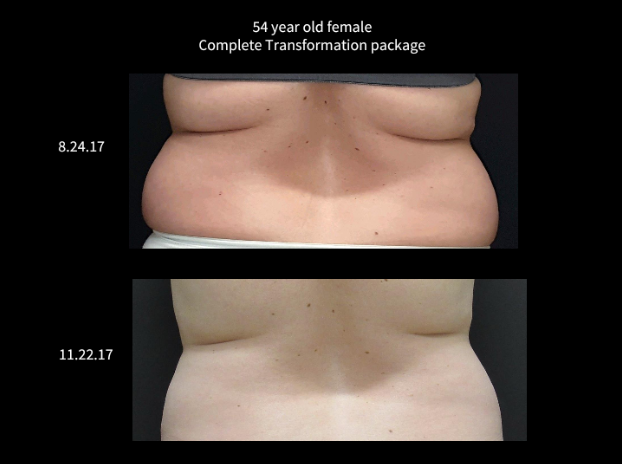 Coolsculpting® Before and After