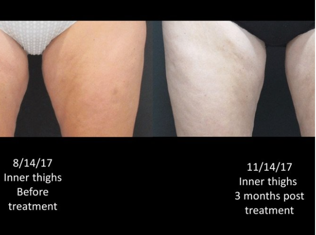 Coolsculpting® Before and After