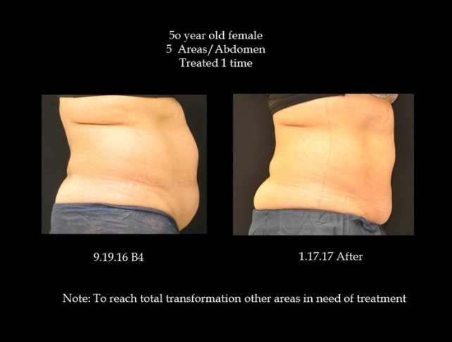 Coolsculpting® Before and After