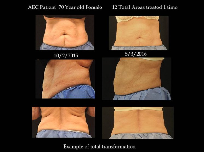 Coolsculpting® Before and After