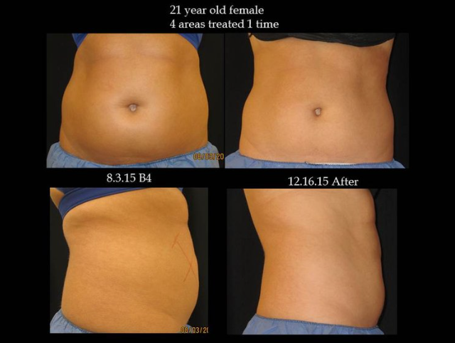 Coolsculpting® Before and After