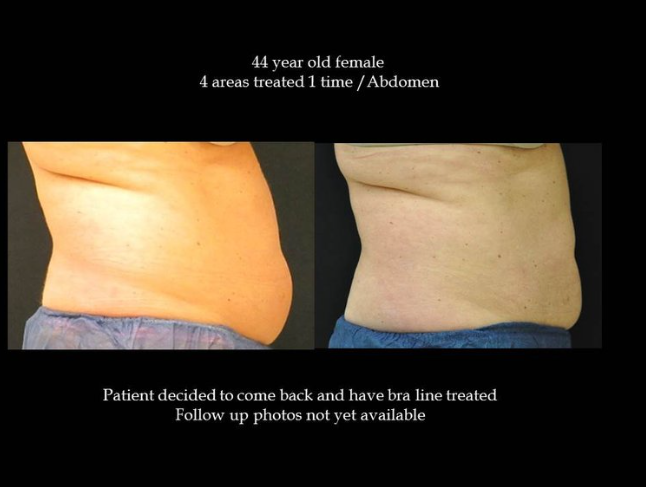 Coolsculpting® Before and After