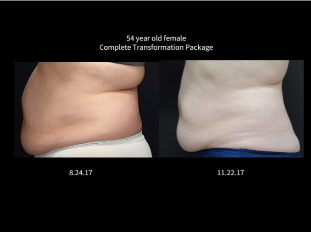 Coolsculpting® Before and After