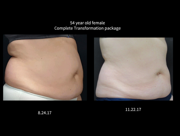 Coolsculpting® Before and After